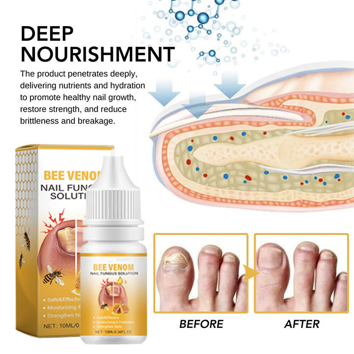BeeVenom Nail Fungus Solution 🔥 Last Day Sale Off 70%🔥