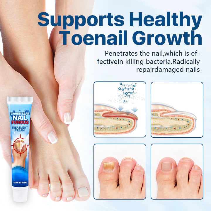 Candiclear Nail Fungus Treatment Cream