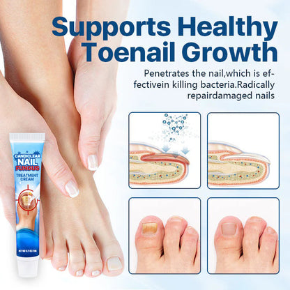 Candiclear Nail Fungus Treatment Cream