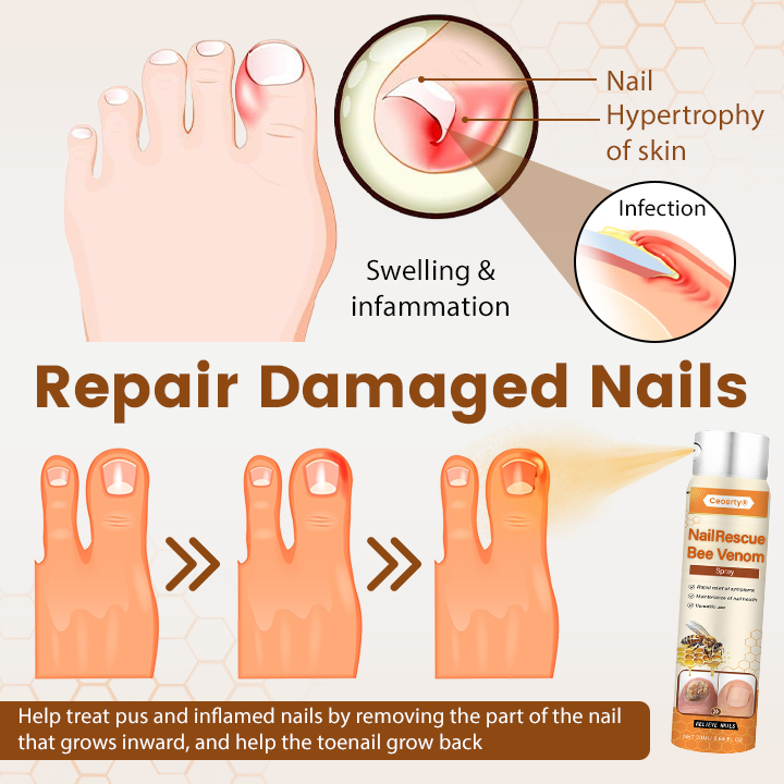 NailRescue Bee Venom Spray