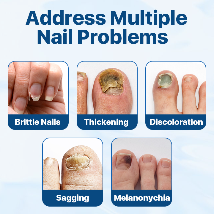 Candiclear Nail Fungus Treatment Cream