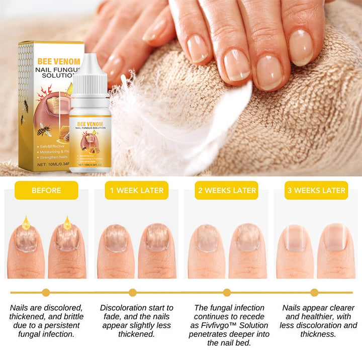 BeeVenom Nail Fungus Solution 🔥 Last Day Sale Off 70%🔥