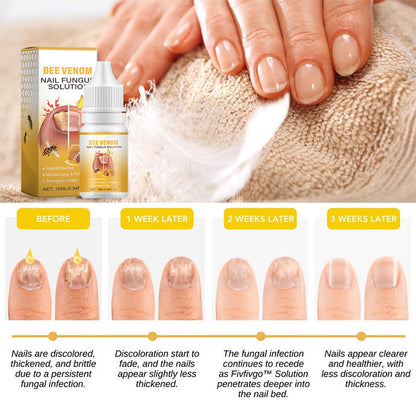 BeeVenom Nail Fungus Solution 🔥 Last Day Sale Off 70%🔥