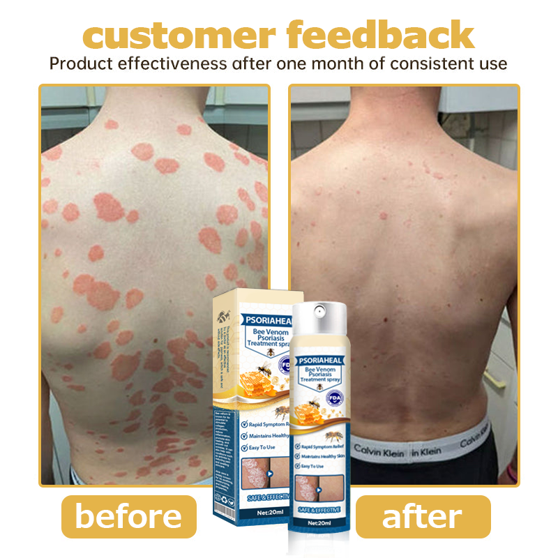 PsoriaHeal Bee Venom Psoriasis Treatment Spray 🔥 Last Day Sale Off 60%🔥