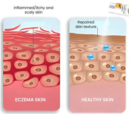 Bee Venom Eczema Treatment Spray – 💥 Last Day Sale Off 60% 🔥